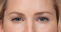 botox after