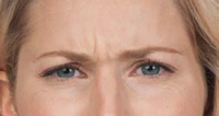 botox before