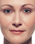 after Cosmetic Facial Fillers