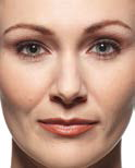 before Cosmetic Facial Fillers