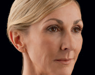 voluma after