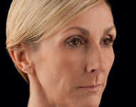 voluma before
