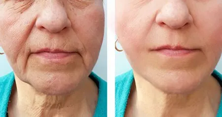 before and after facelift