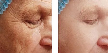 before and after Cosmetic Facial Fillers